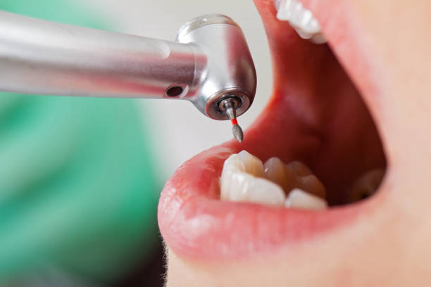 Best Emergency Tooth Extraction in San Fernando, CA